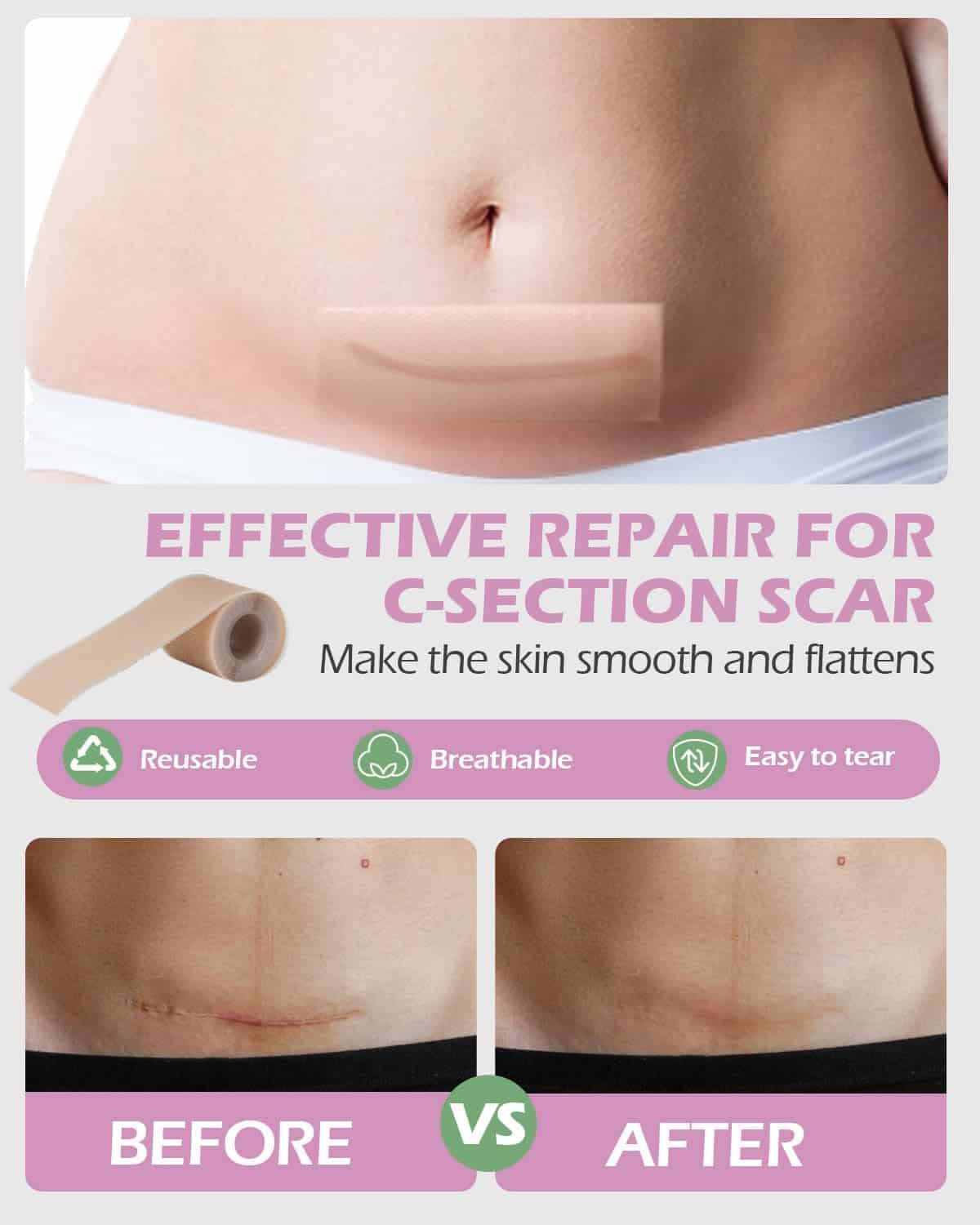 Kit de Recuperación Parto Cesárea